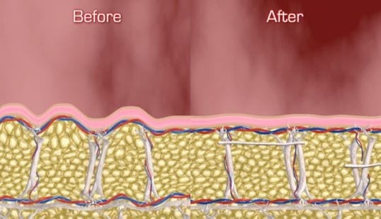 Cellfina – Cellulite Treatment - El Paso, TX Southwest Plastic 