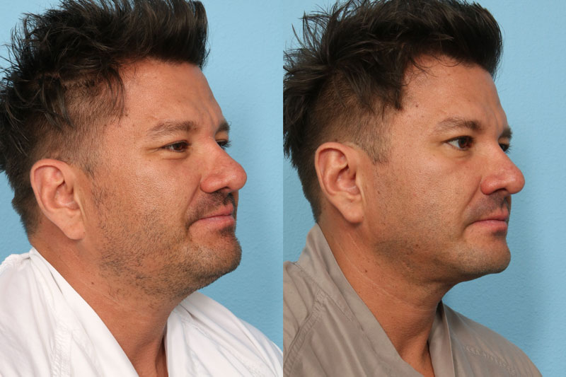 EmbraceRF Before and After