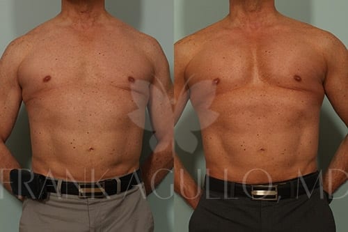 Pectoral Implants Before and After Surgery