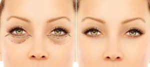 Before and after eyelid surgery picture of a woman's eyes