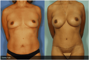 Tummy Tuck Before & After Photos