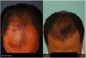 The Facts about Hair Loss