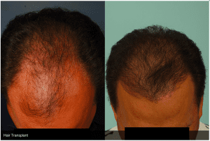 Dr. Agullo Hair Transplant Before and After Photos