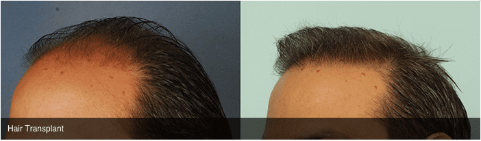 Hair Transplant Before and After Photos