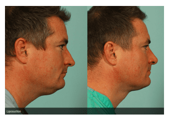 Why Men Should Consider Plastic Surgery?