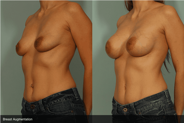 Breast Augmentation Before and After