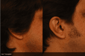 Hair Transplant Before and After