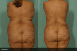 How Long Does Liposuction Treatment Last?