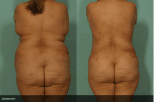 Liposuction Before and After