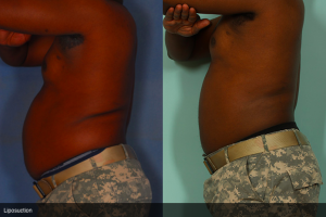 Liposuction Before and After