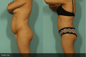 Tummy Tuck Surgery Before and After