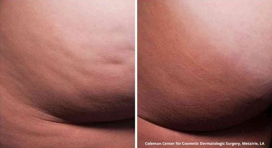 Cellulite Treatment Before and After Photos