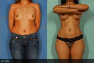 Liposuction Before and After