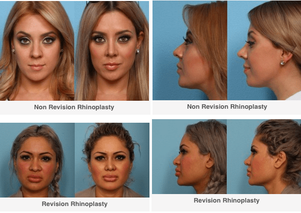 Non Revision and Revision Rhinoplasty