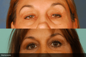 Before and After Blepharoplasty