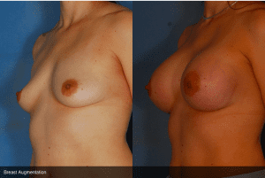 Before and After Breast Augmentation