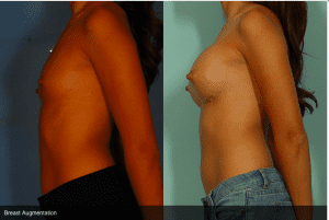 Before and After Breast Augmentation