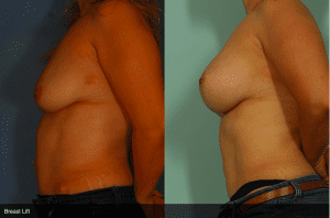 Before and After Breast Lift