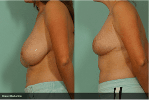 Before and After Breast Reduction