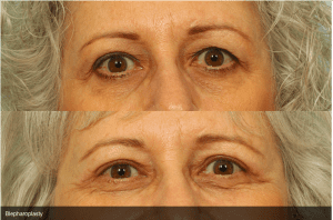 Before and After Eyelift Surgery