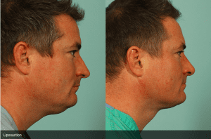 Before and After Male Neck Liposuction