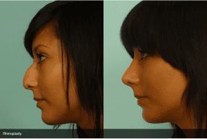 Before and After Rhinoplasty