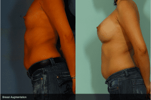 Breast Augmentation Before and After