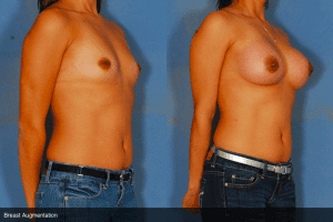 Breast Augmentation Before and After Photos