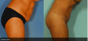 Avant et après une abdominoplastie