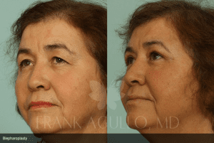 Before and After Blepharoplasty