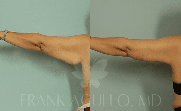 How to Tone Your Arms After Massive Weight Loss - Frank Agullo, MD