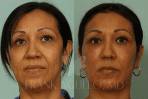 Facelift Before and After Photos