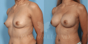 before-and-after-breast-augmentation