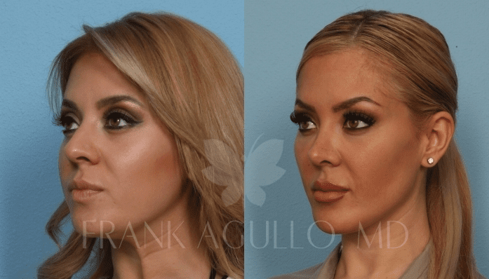 How to Achieve a Chiseled Jawline - Zcosmetic Health