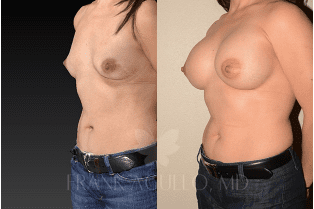 Breast Augmentation Results