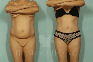Tummy Tuck Surgery Before and After