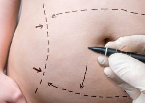 Which Tummy Tuck Is Right for Me?