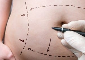 Woman Being Marked Before Tummy Tuck Surgery