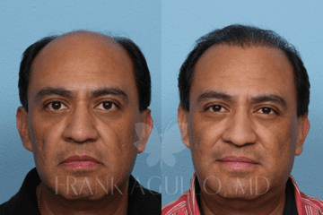 Hair transplant male patient 2 before and after by Dr. Agullo