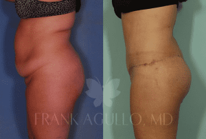 Dr. Agullo Body Lift Patient