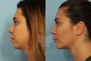 Buccal Fat Pad Removal by Dr. Agullo