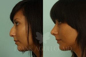 Open Nose Surgery vs. Closed Nose Surgery