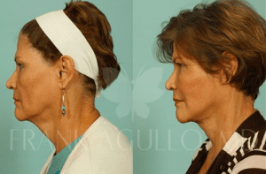 What Is Involved in Neck Lift Surgery?