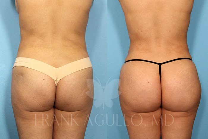 Brazilian Butt Lift Before and After 7
