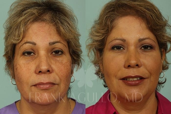 fat-injections-before-and-after-agullo-case-3-img-blog