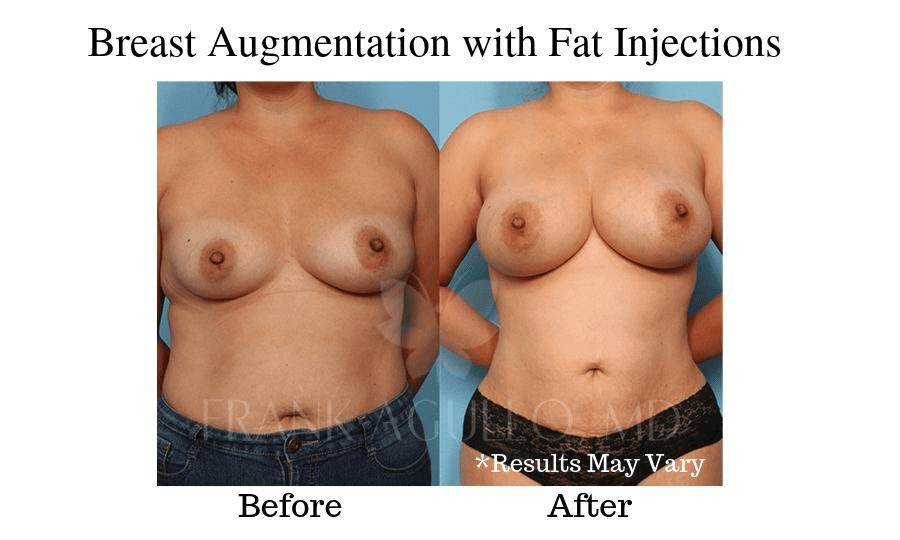 Before and after image showing results of a breast augmentation using fat injections in El Paso, Texas.