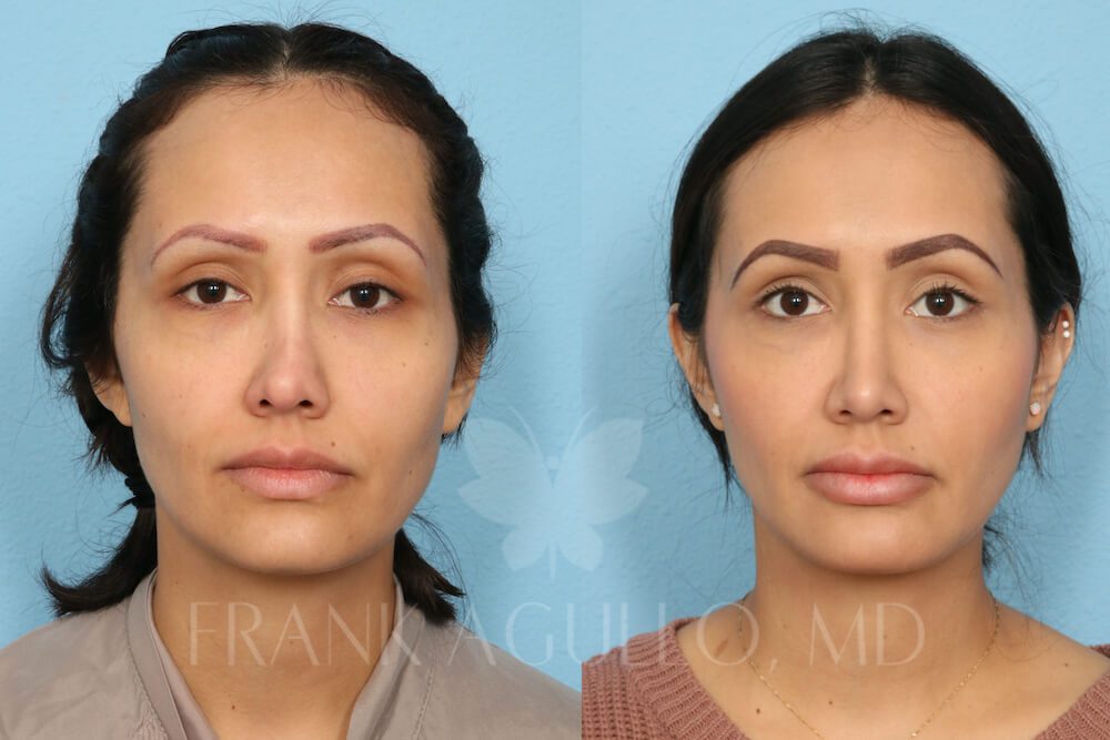 Before and after image showing the results of a revision rhinoplasty performed in El Paso, TX.