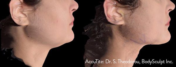 accutite before & after