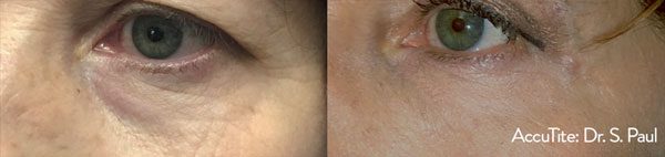 accutite before and after