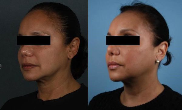 thread facelift before and after 3